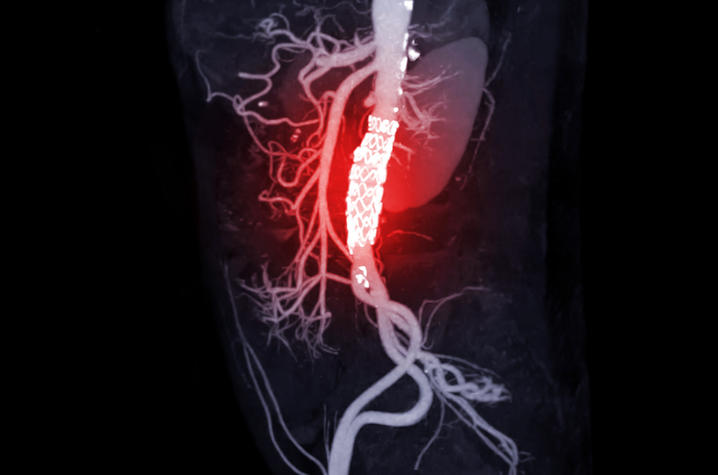 CTA of the abdominal aorta